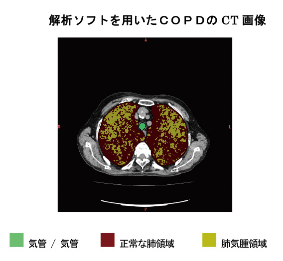 慢性 肺気腫